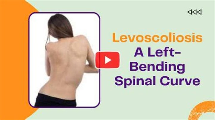 how serious is levoscoliosis