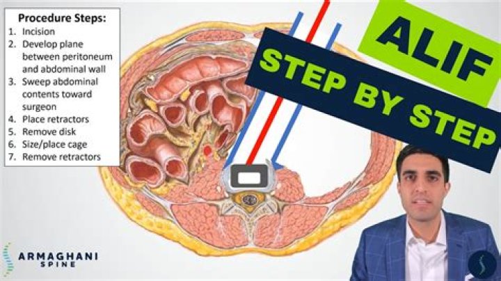 How successful is Alif surgery?