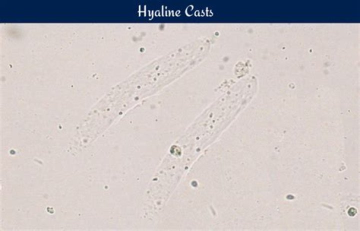 hyaline casts in urine