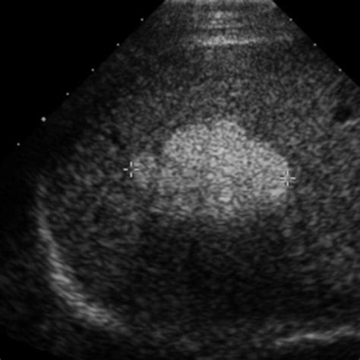 hyperechoic liver