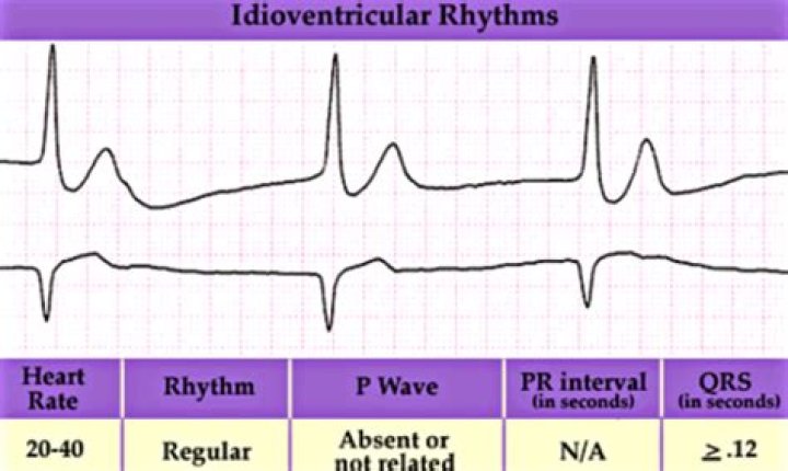 idioventricular rhythm vs junctional