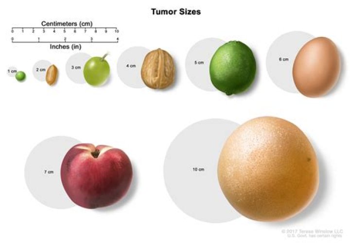 Is 4 cm a large tumor?