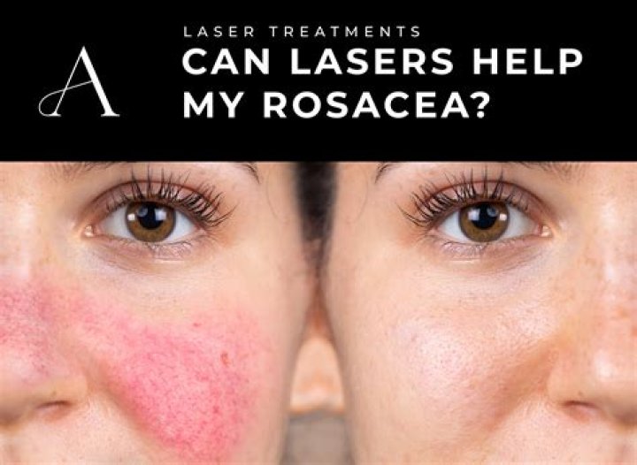 Is a humidifier good for rosacea