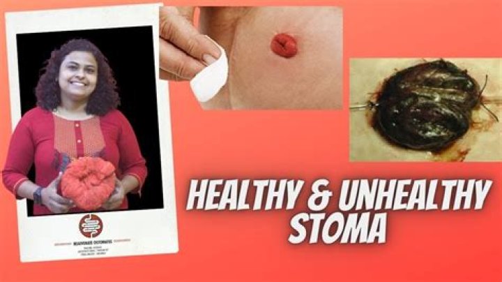 Is a purple colored stoma normal