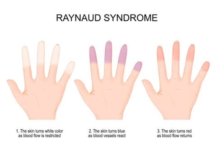 Is Raynaud phenomenon autoimmune