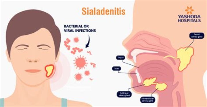 Is Sialadenitis serious