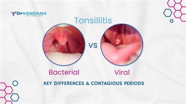 is tonsillitis contagious