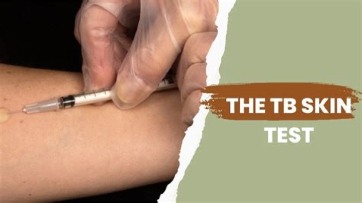 itchy tb test