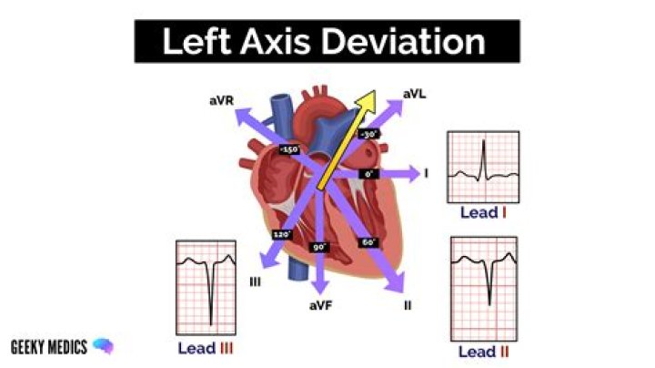 left axis deviation
