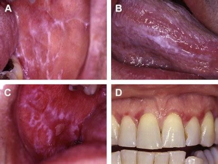 lichenoid mucositis