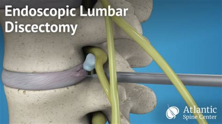 lumbar discectomy cpt code