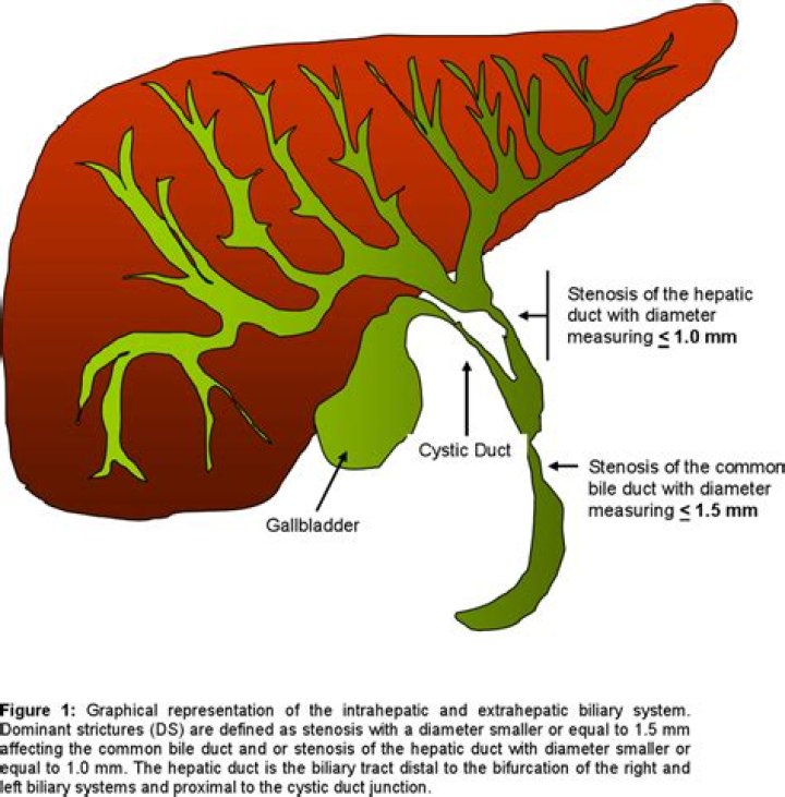 mild intrahepatic biliary dilatation
