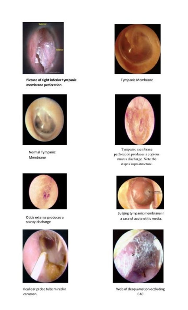 normal color of tympanic membrane