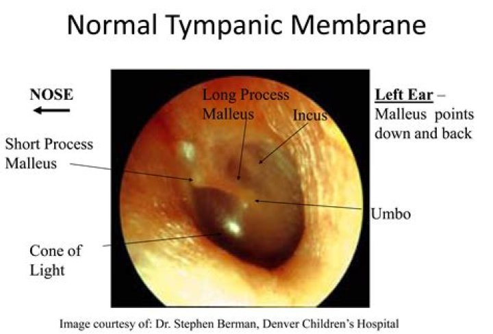 normal tympanic membrane