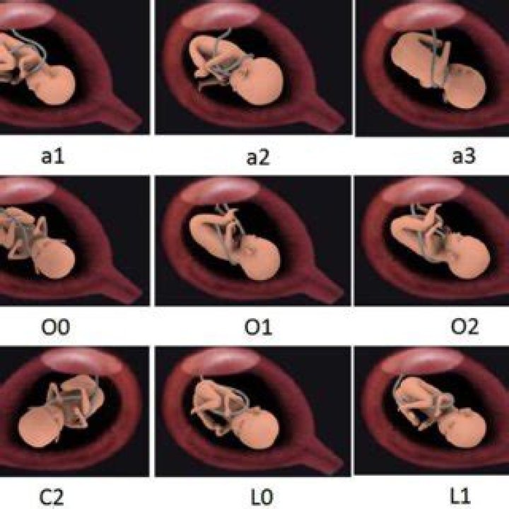 nuchal cord x2