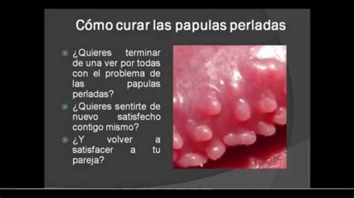 pápulas perladas porque salen