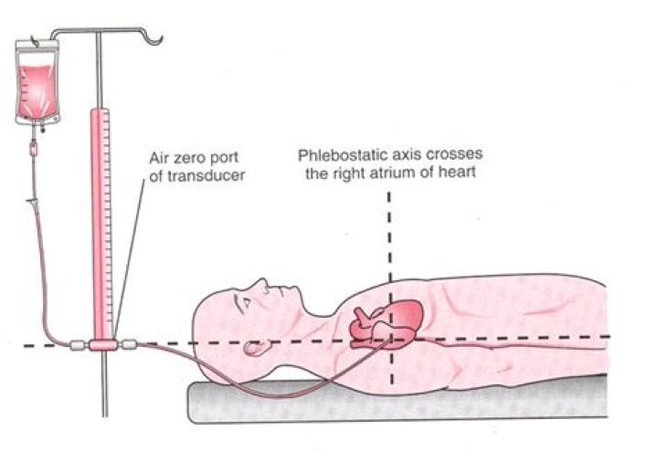 phlebostatic axis