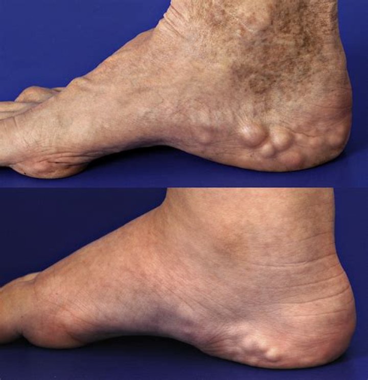 piezogenic papules