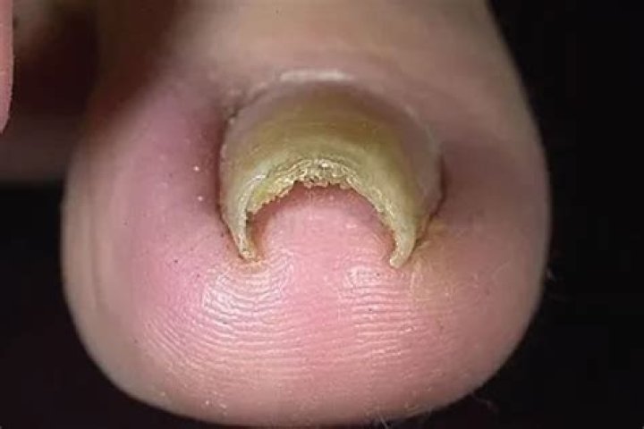 pincer toenail