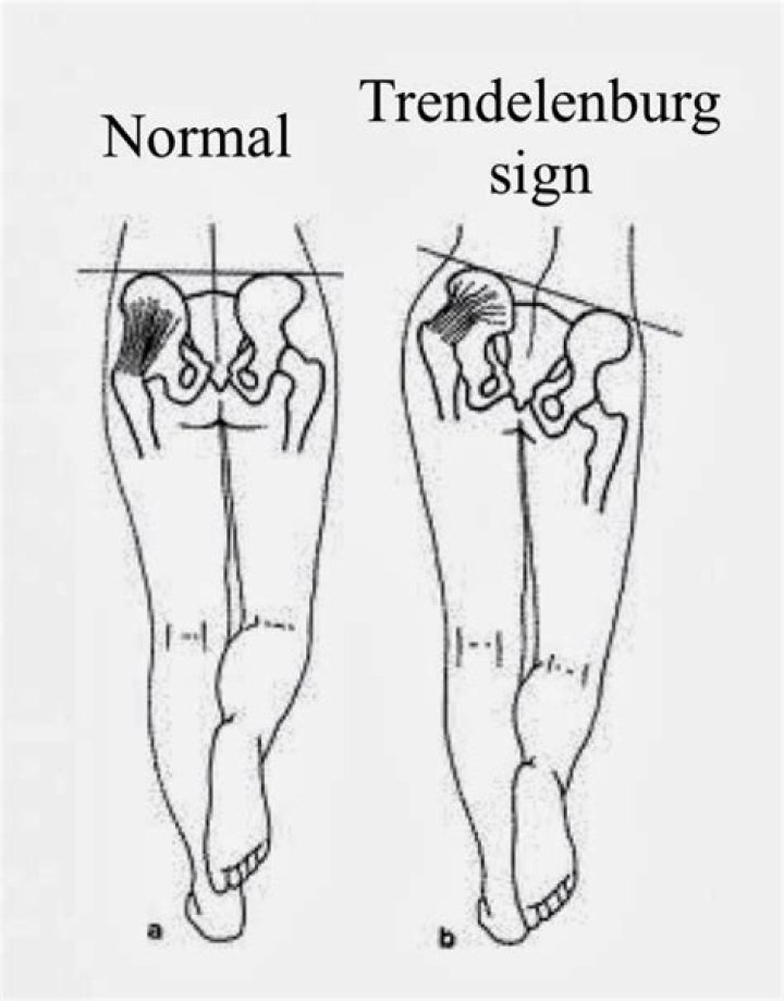 positive trendelenburg sign