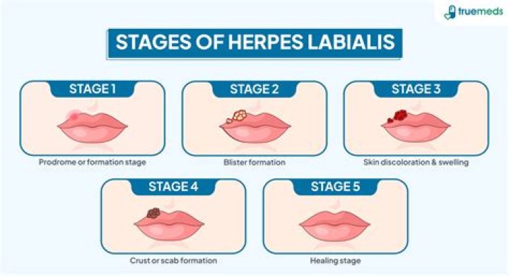 prodromal herpes symptoms