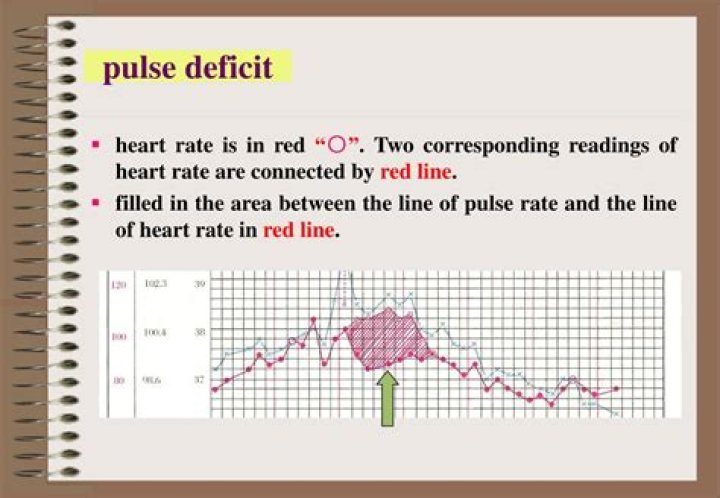 pulse deficit