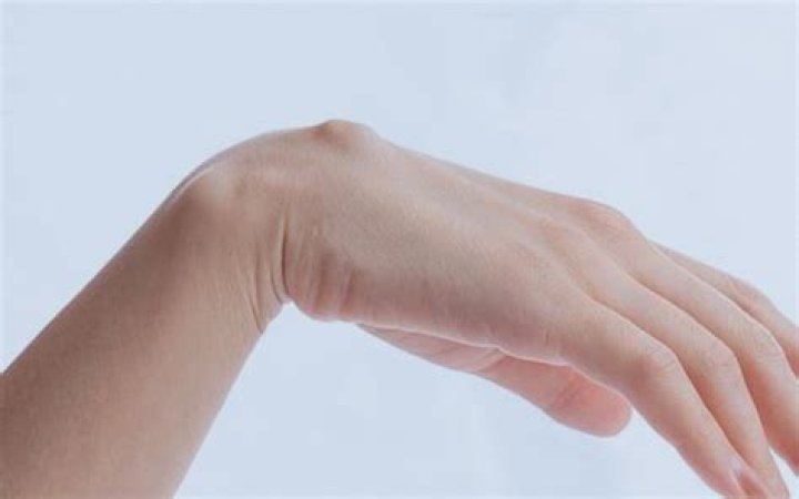 ¿Qué es un quiste ganglionar en el pie