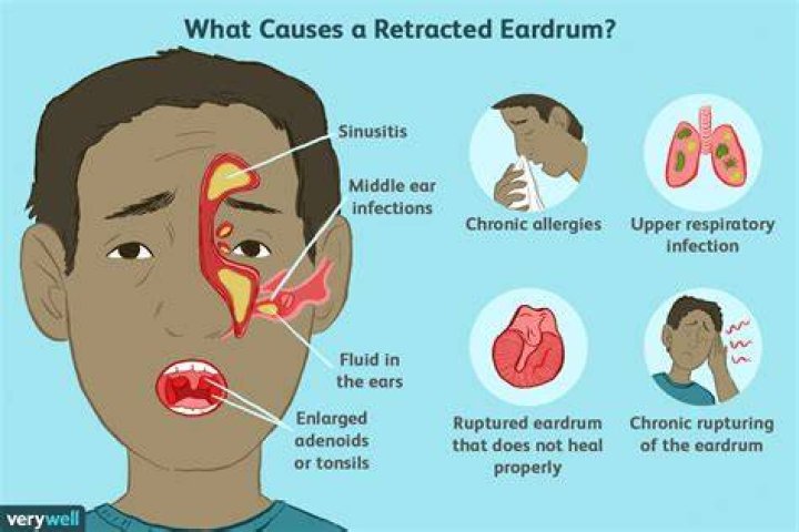 retracted eardrum symptoms