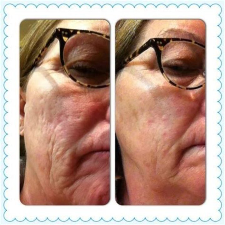 rodan and fields amp roller before and after