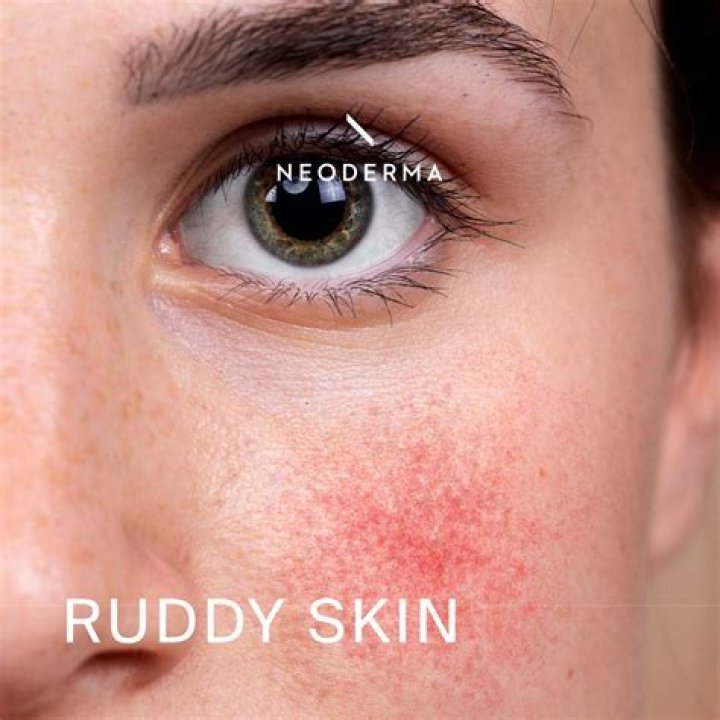 ruddy skin