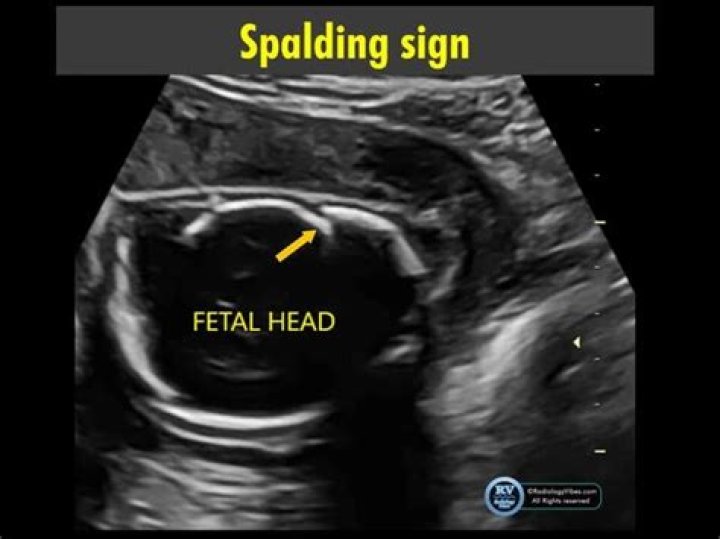 spalding’s sign