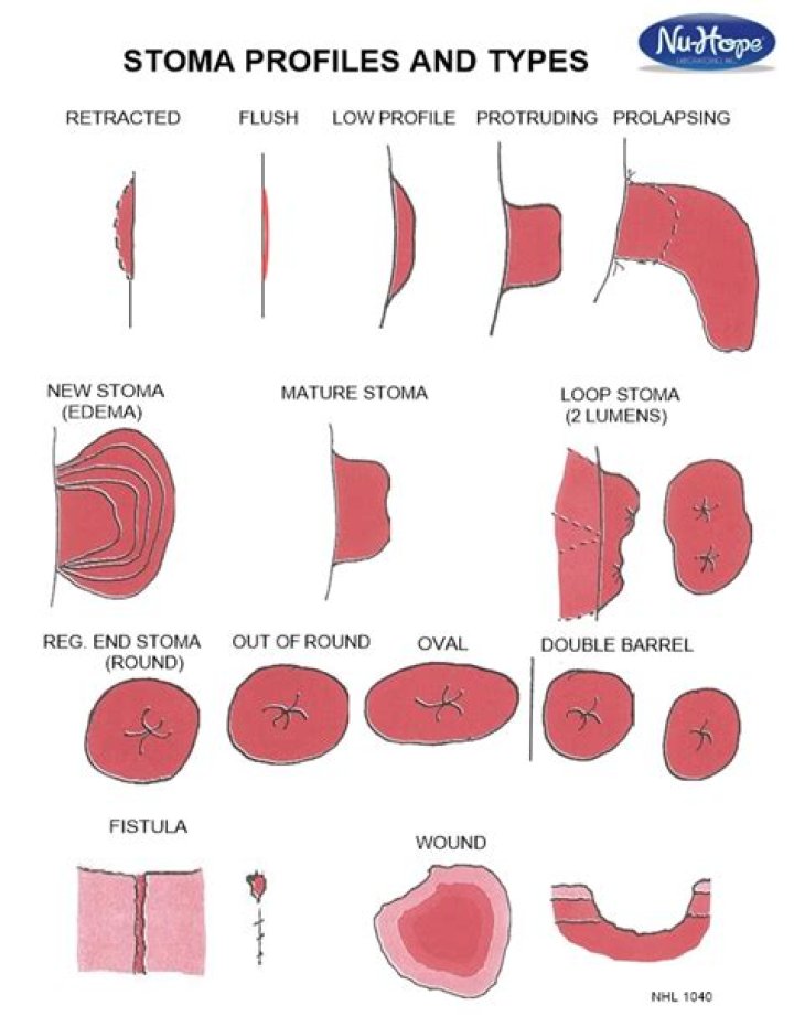 stoma appearance