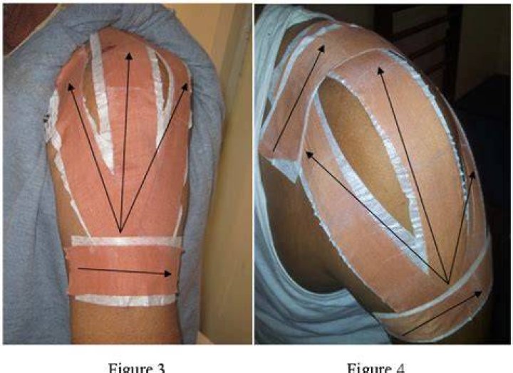 taping for shoulder subluxation