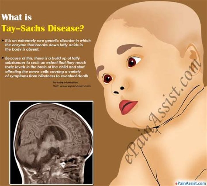 tay sachs disease life expectancy