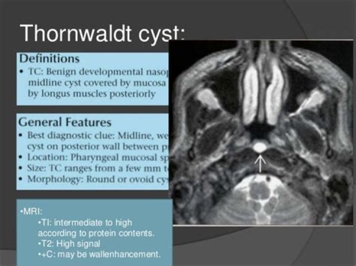 tornwaldt cyst symptoms