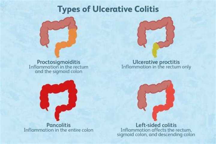 ulcerative colitis icd 10