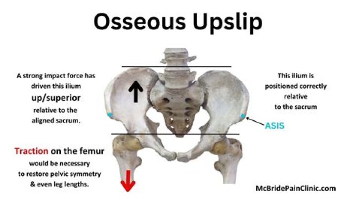 upslip pelvis