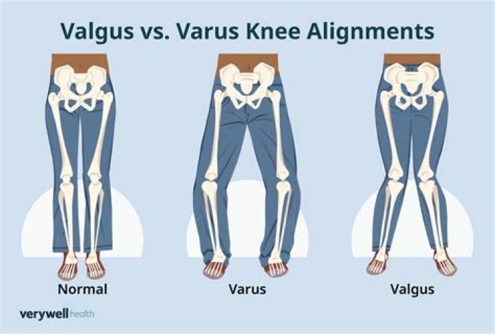 valgus vs varus