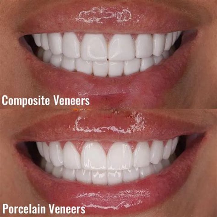 What are feldspathic veneers? | ContextResponse.com