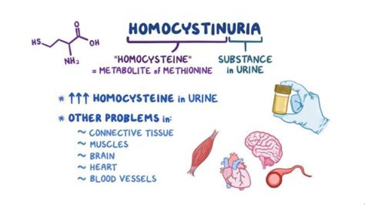 What are the symptoms of homocystinuria