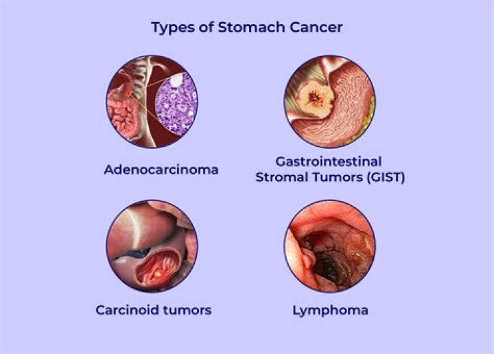 What are the types of abdominal cancer?