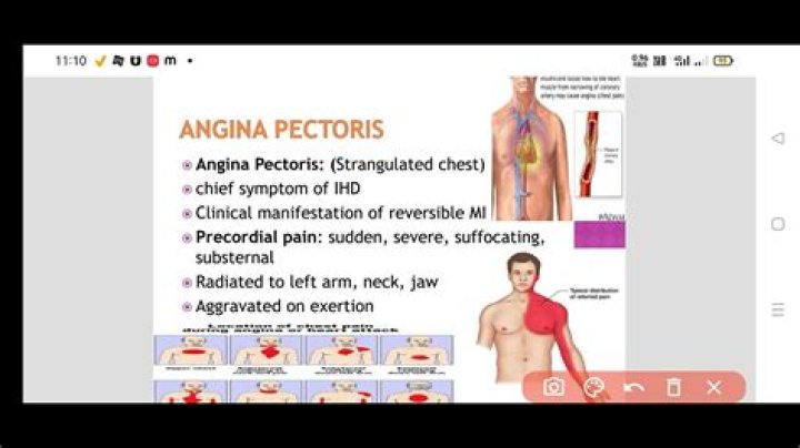 What are types of angina pectoris