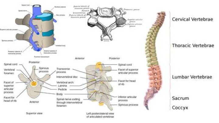 What causes a limbus vertebra