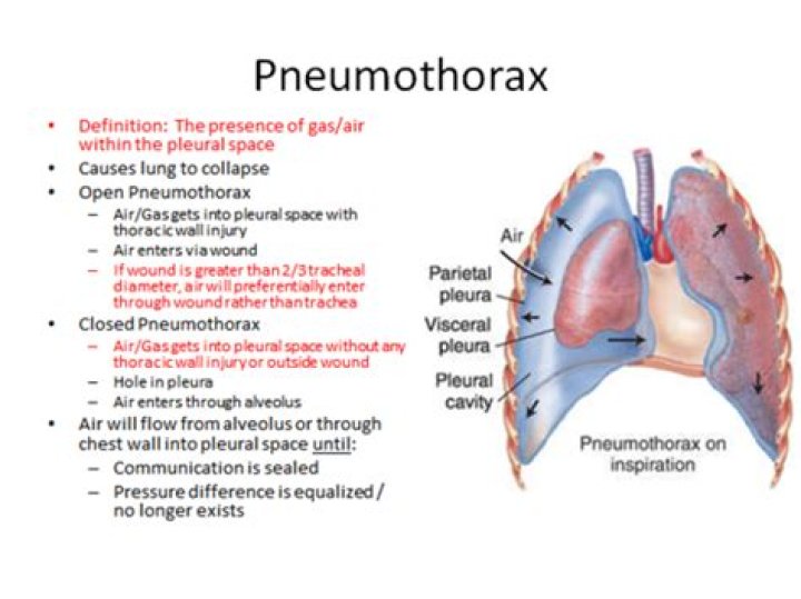 What causes a spontaneous pneumothorax