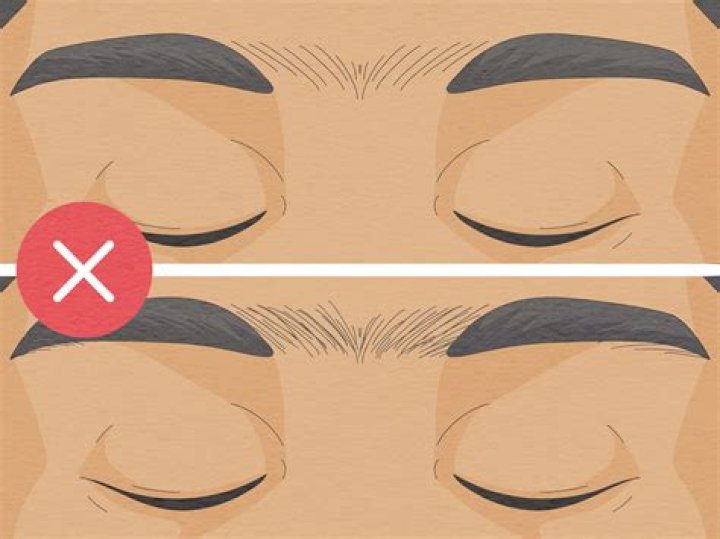 what causes a unibrow