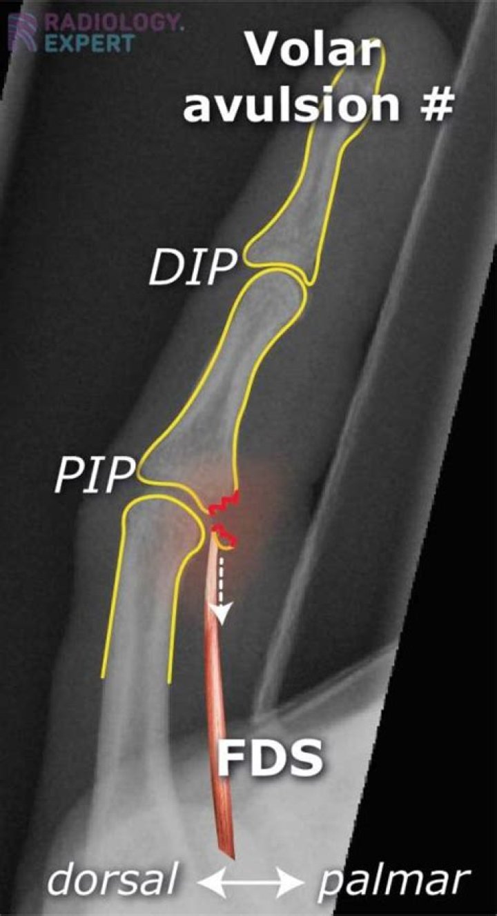 What causes an avulsion