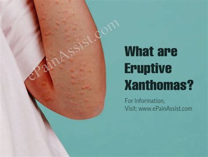 What causes eruptive Xanthomas