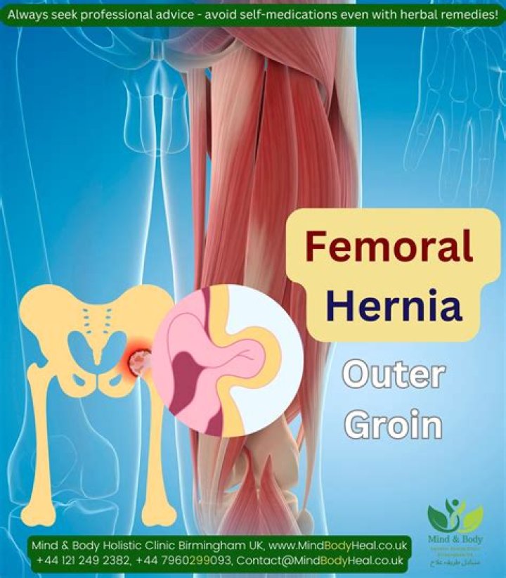 What causes femoral hernia? | ContextResponse.com