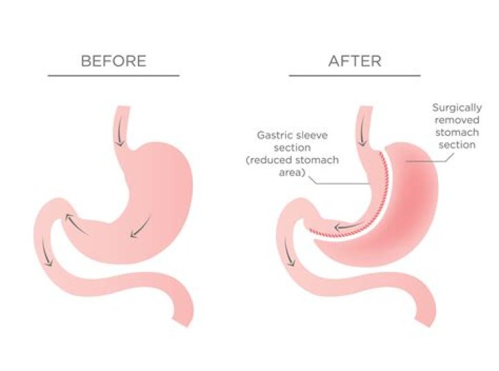 what causes hiccups after gastric sleeve