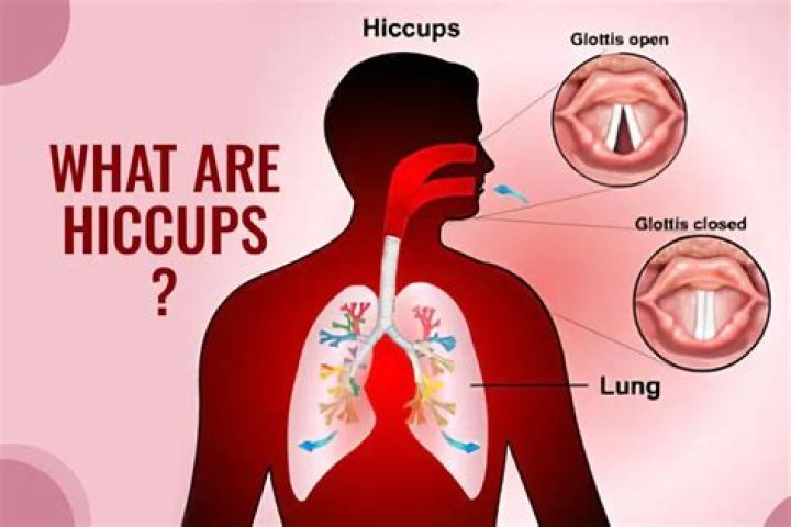 what causes hiccups often